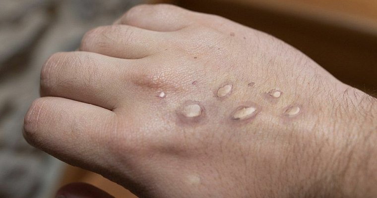 Из огня да в полымя: в Таиланде зафиксирован первый случай оспы обезьян