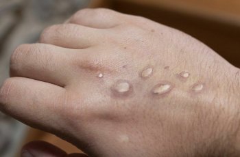 Из огня да в полымя: в Таиланде зафиксирован первый случай оспы обезьян
